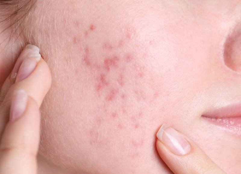 Kesalahan Skincare yang Membuat Bekas Jerawat Semakin Sulit Hilang