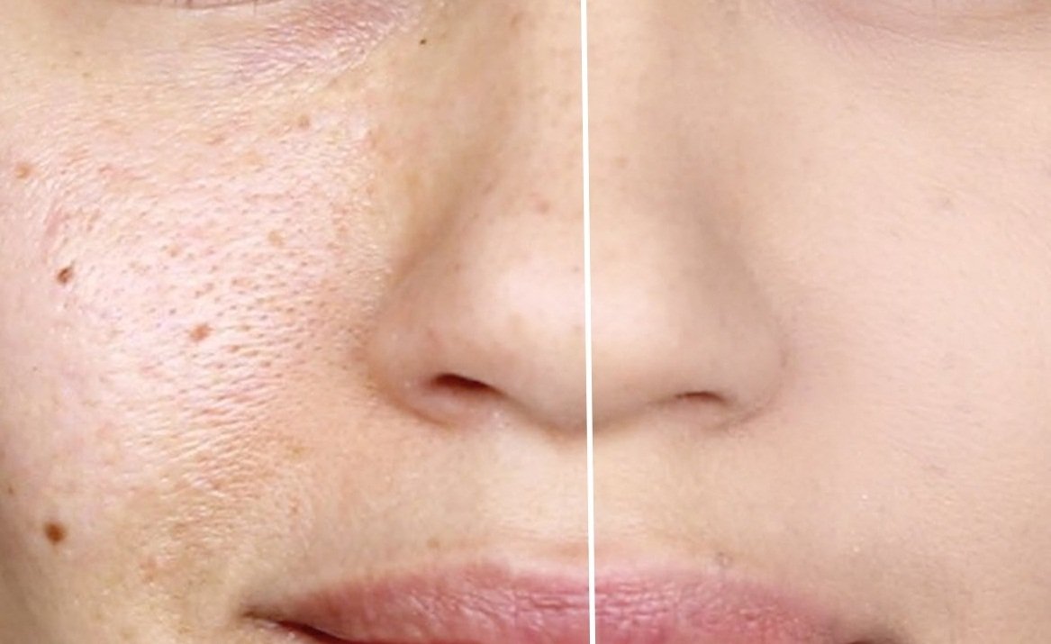 Penyebab Pori-Pori Terlihat Besar: Bukan Sekadar Masalah Kulit Berminyak