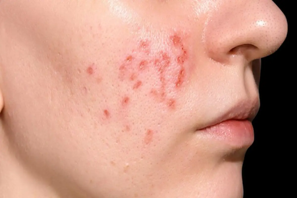 Perbedaan Jerawat Hormonal dan Jerawat Biasa: Kenali Jenisnya agar Tidak Salah Perawatan