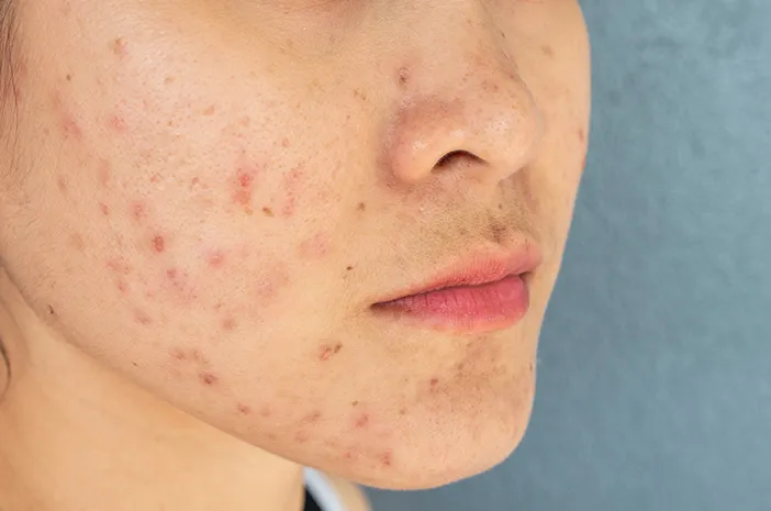 Berapa Lama Purging yang Masih Tergolong Normal? Ini Batas Wajarnya