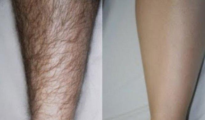 Mencukur Bulu Kaki: Manfaat, Risiko, dan Fakta yang Perlu Diketahui