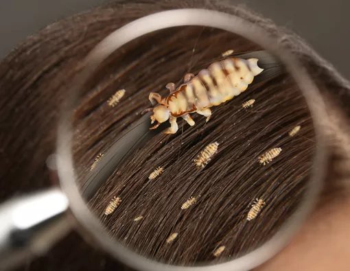 Tips Mengatasi Kutu pada Rambut: Biar Bebas Gatal dan Nggak Balik Lagi
