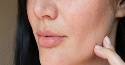 Kulit Kering Tak Kunjung Lembap Meski Sudah Pakai Skincare? Coba Evaluasi 5 Kebiasaan Ini